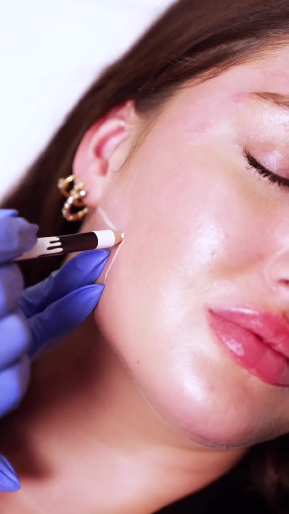 BOTOX® treatment planning