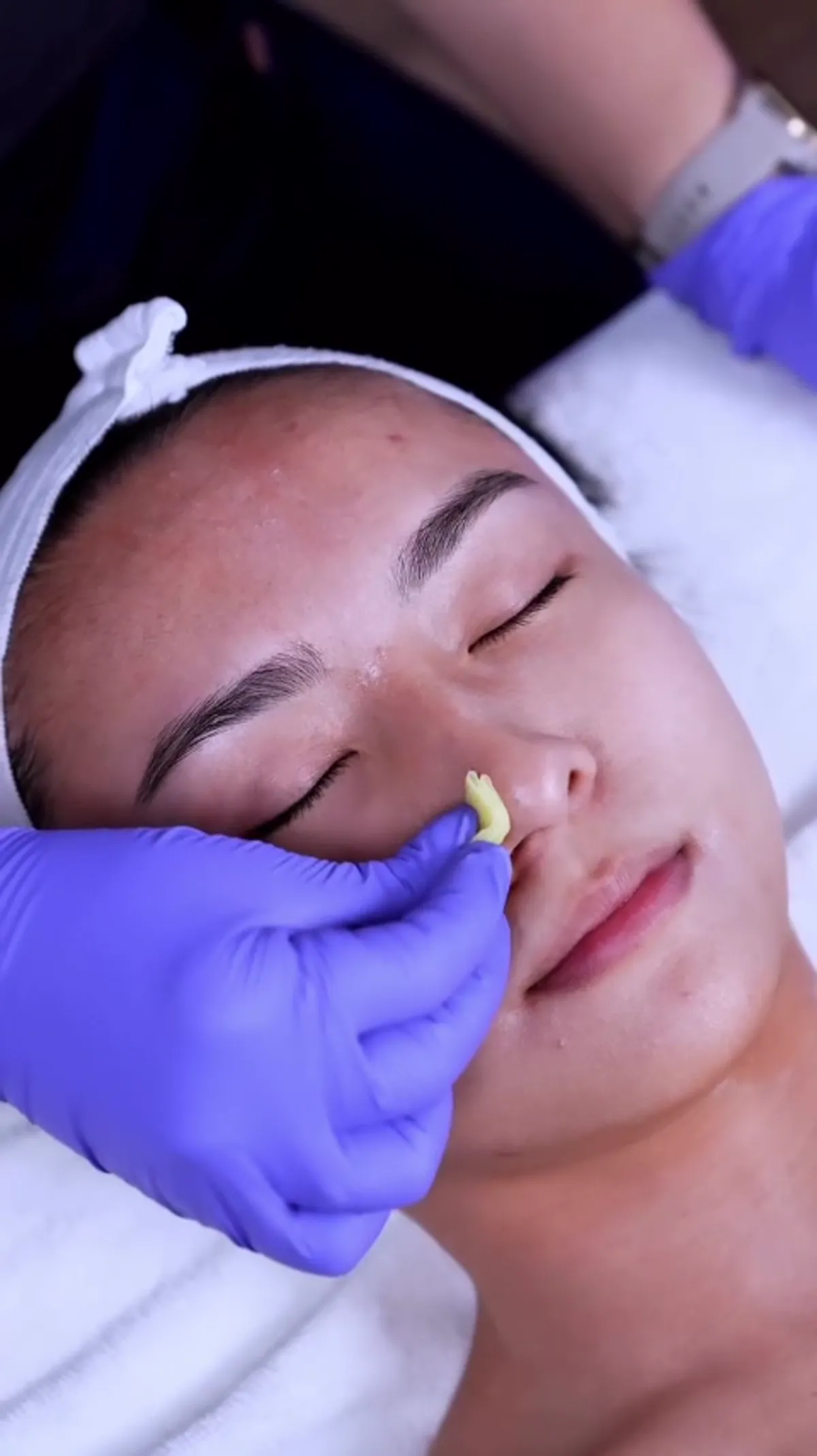 Chemical Peels treatment planning