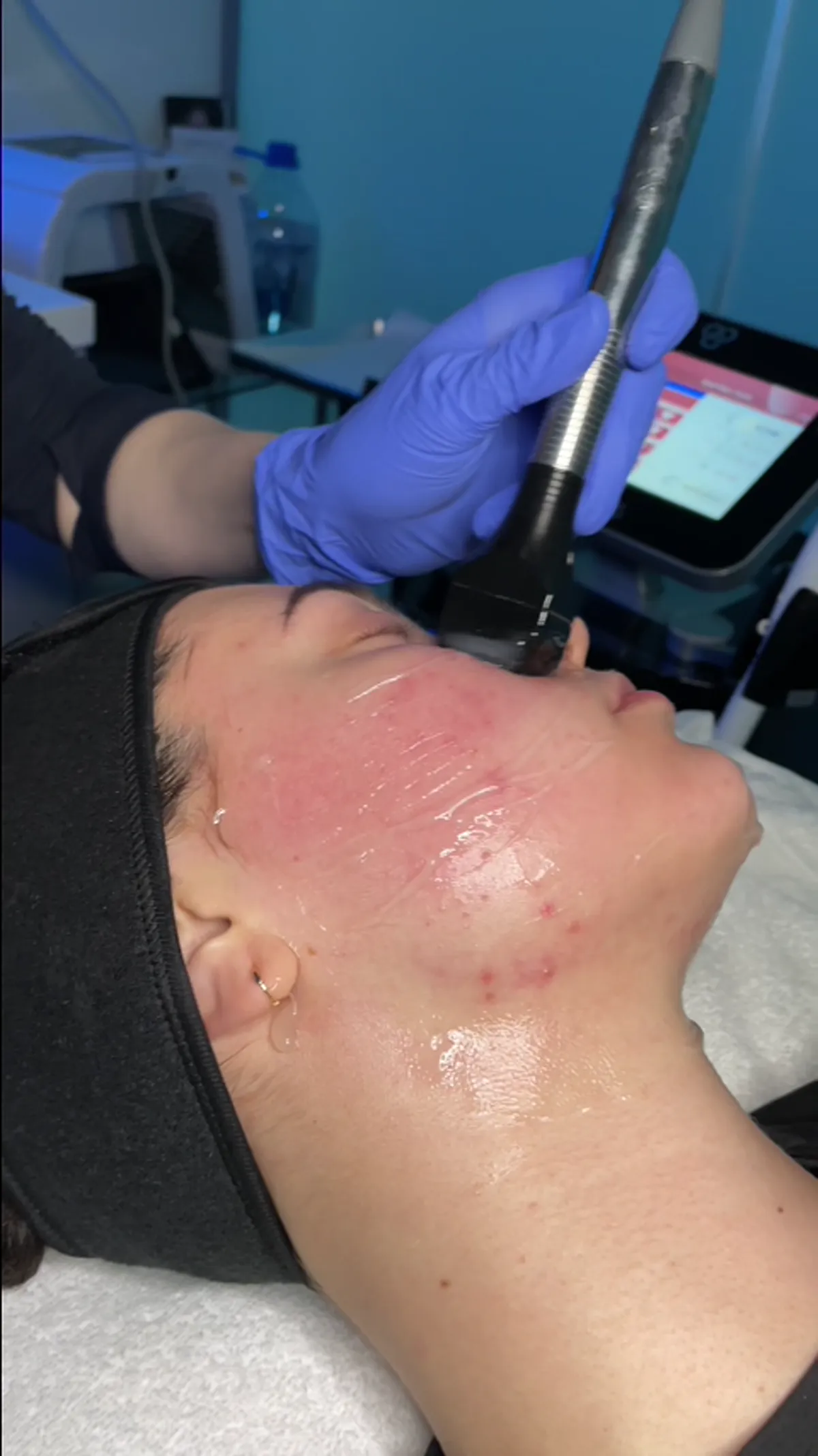 Forma Skin Tightening treatment planning