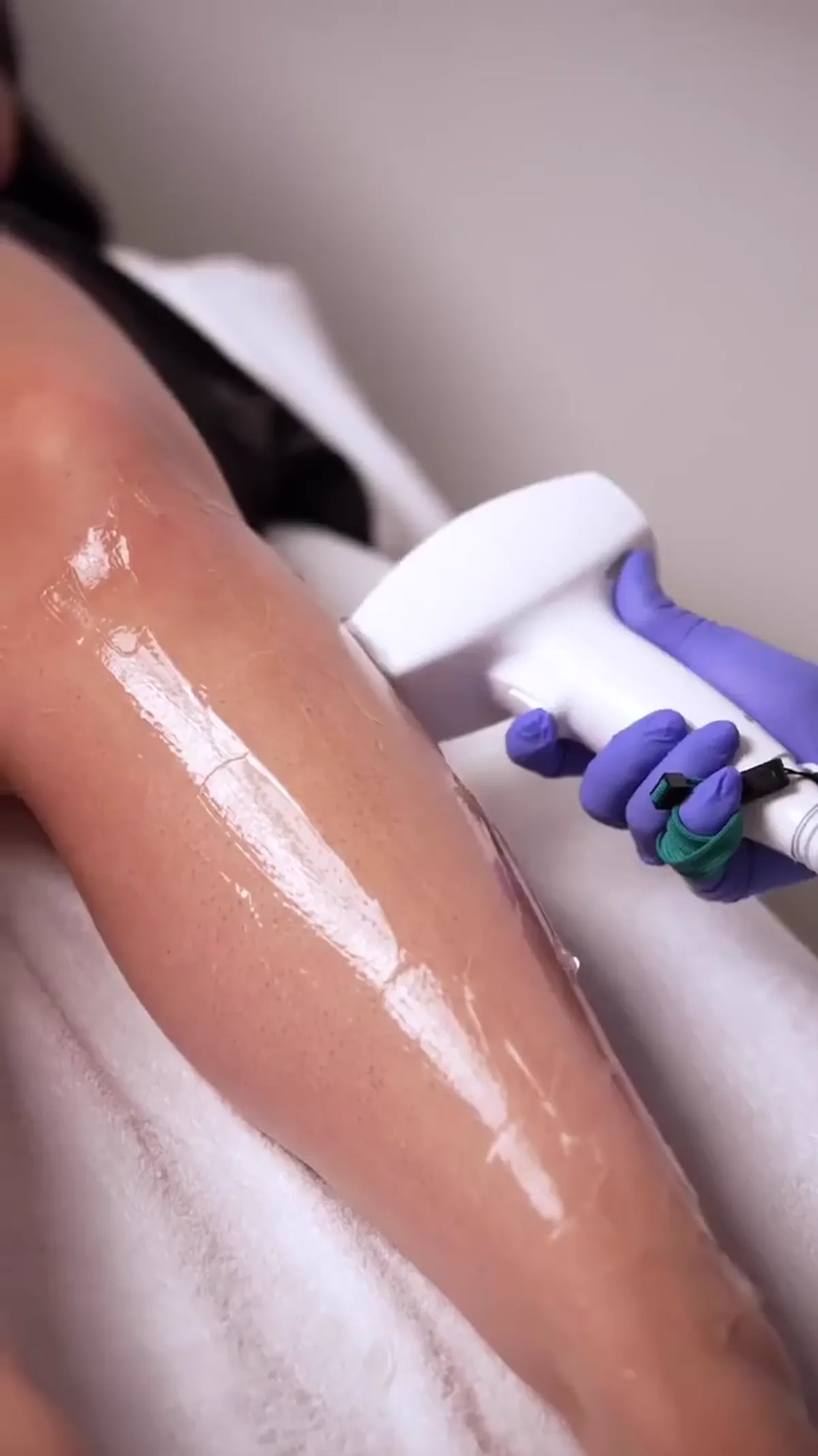 Laser Hair Removal treatment planning