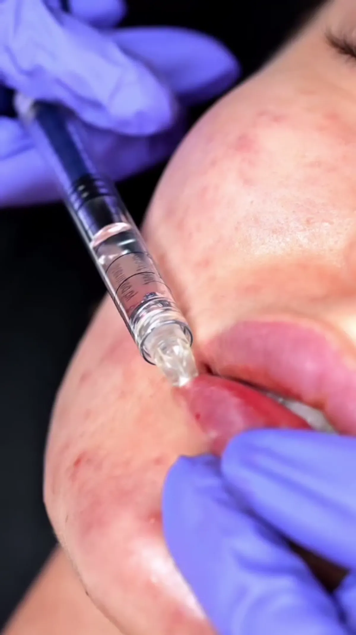 Lip Filler treatment detail