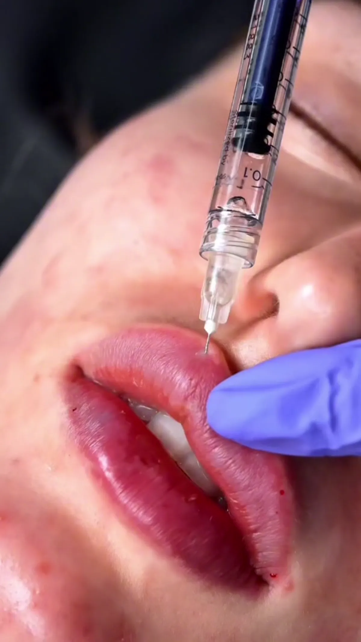 Lip Filler treatment planning