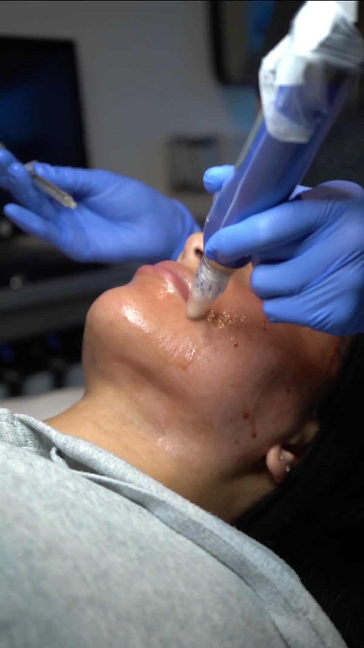 Microneedling treatment detail