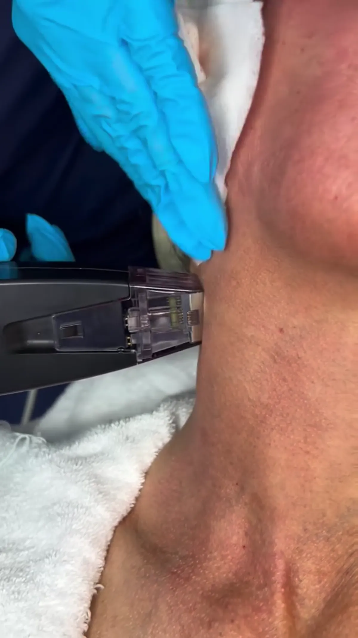 Morpheus8® treatment