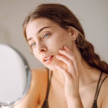 chemical peels for acne scars