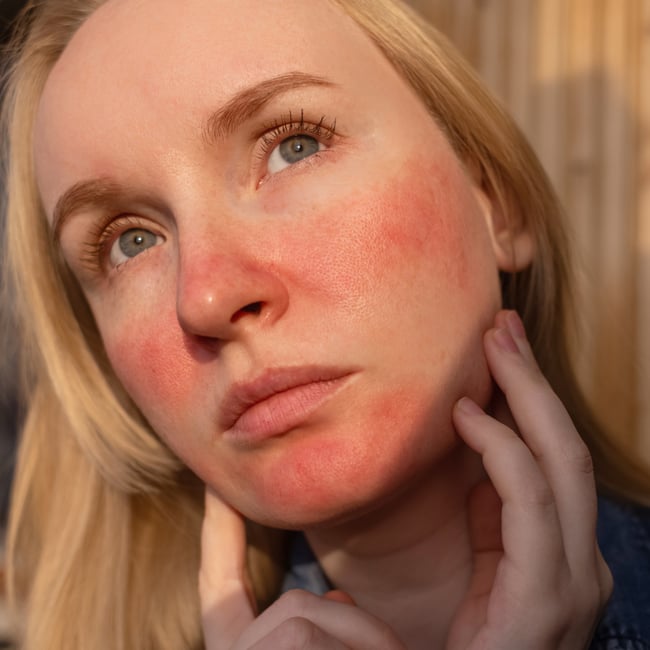 ZO Blog Post Images rosacea triggers treatments
