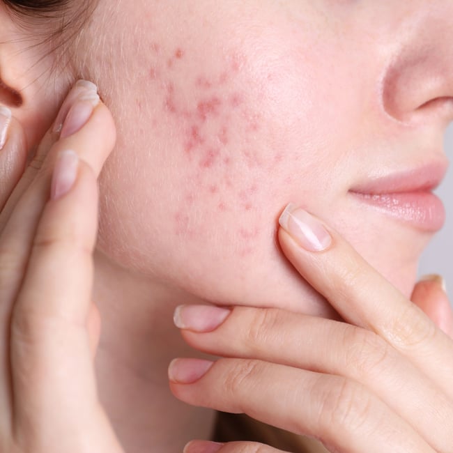 ZO Blog Post Images treatments for acne scars