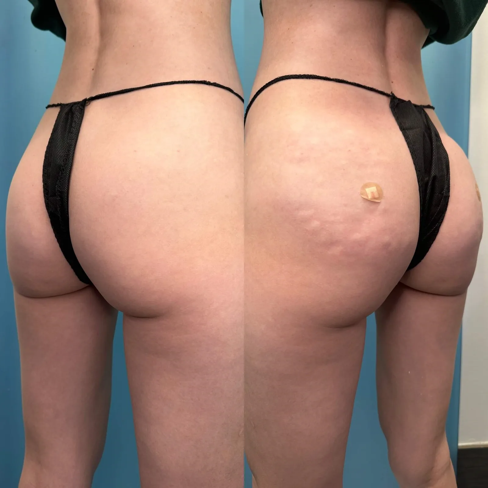 Your Dream Booty With Radiesse