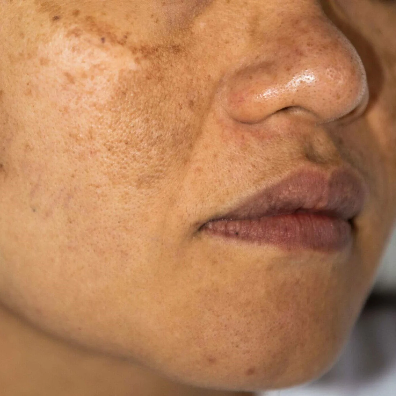 Hyperpigmentation
