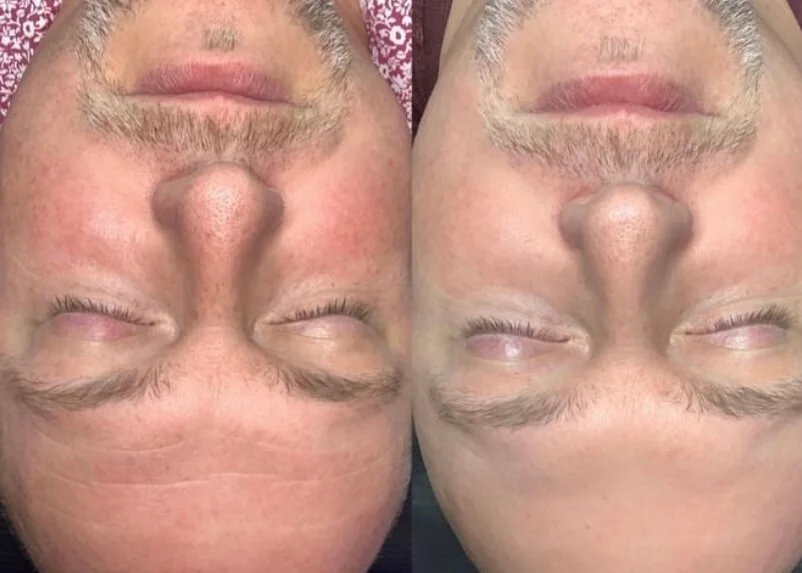 Male patient at ZO Skin Centre Dallas after 4 weeks of using Daily Power Defense and Rozatrol