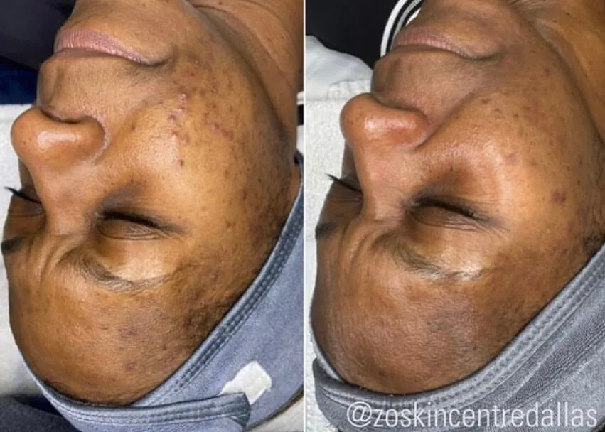 Hydrafacials