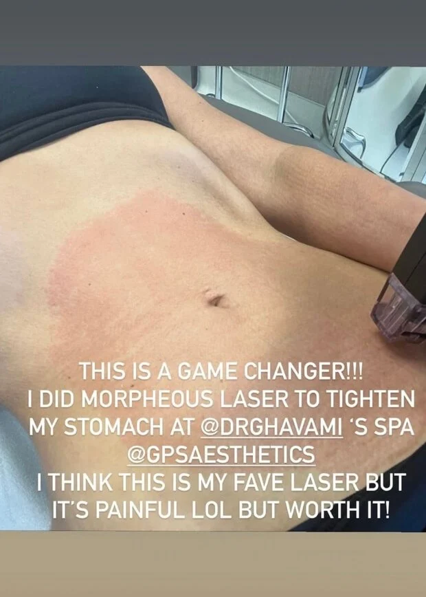 Kim Kardashian does Morpheus8 to get her abs