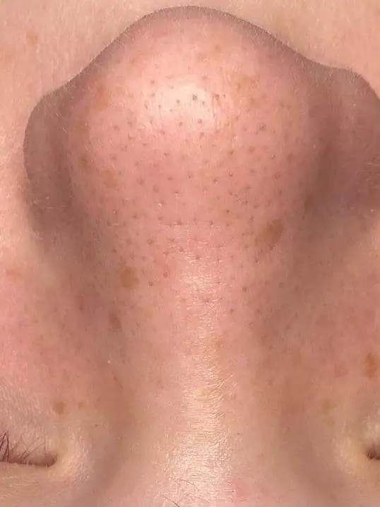 HydraFacial® with Extended Extractions before treatment