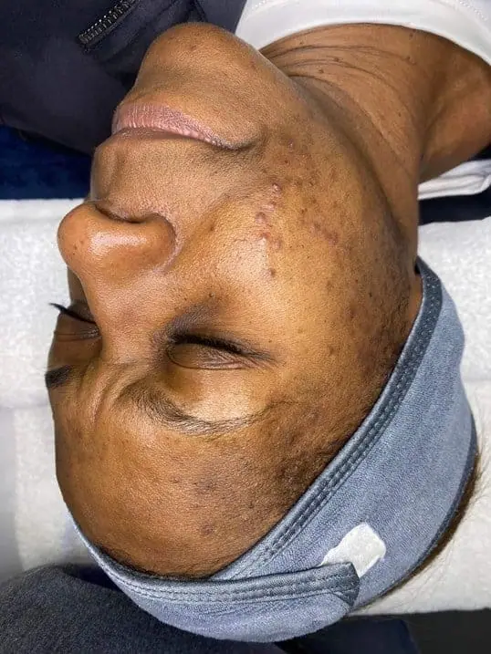 Acne and hyperpigmentation solutions before treatment