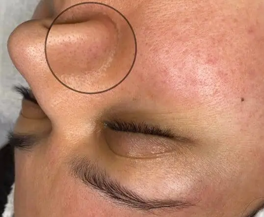 SkinPen Microneedling for Clogged Pores & Congestion before treatment