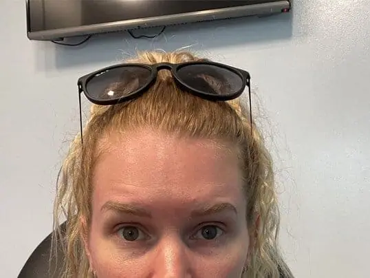 ZO Skin Centre patient results after treatment at ZO Skin Centre