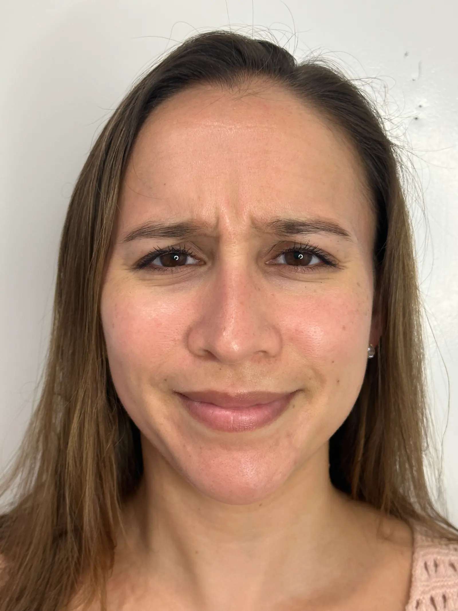 Upper-Face BOTOX® by Mini before treatment