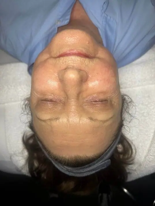 Chemical Peels after treatment at ZO Skin Centre