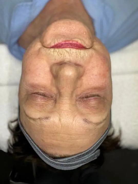 ZO Skin Peel + Dermaplaning Treatment before treatment