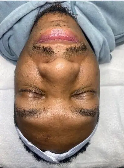 Younger, firmer, more radiant skin awaits with Microneedling! before treatment