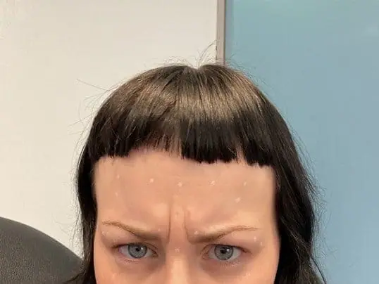 Dysport® before treatment at ZO Skin Centre
