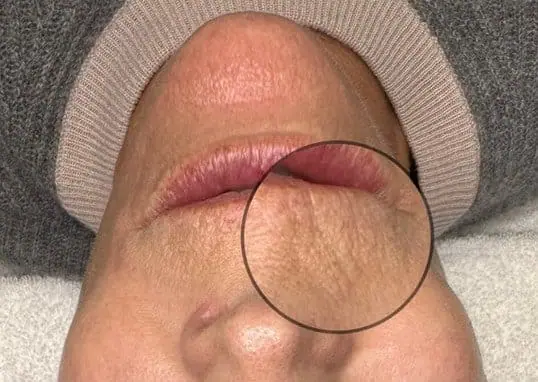 Morpheus8® - RF Skin Tightening before treatment