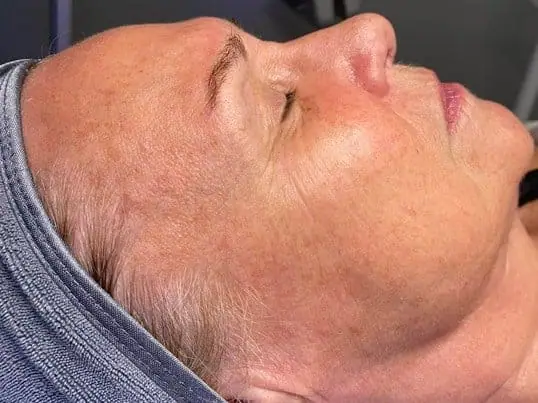 HydraFacial® after treatment at ZO Skin Centre