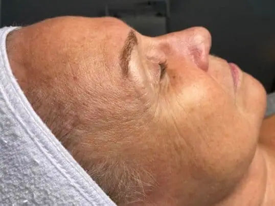 HydraFacial® before treatment at ZO Skin Centre