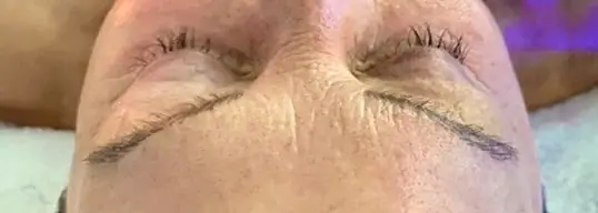Deluxe HydraFacial®: Immediate Results before treatment
