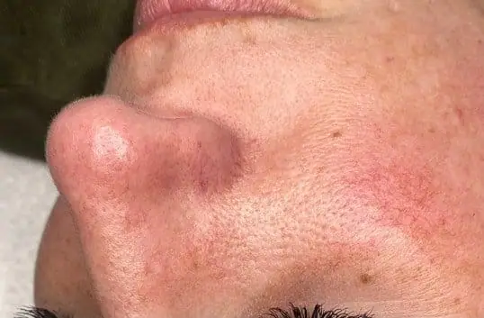 HydraFacial® Treatment Result before treatment