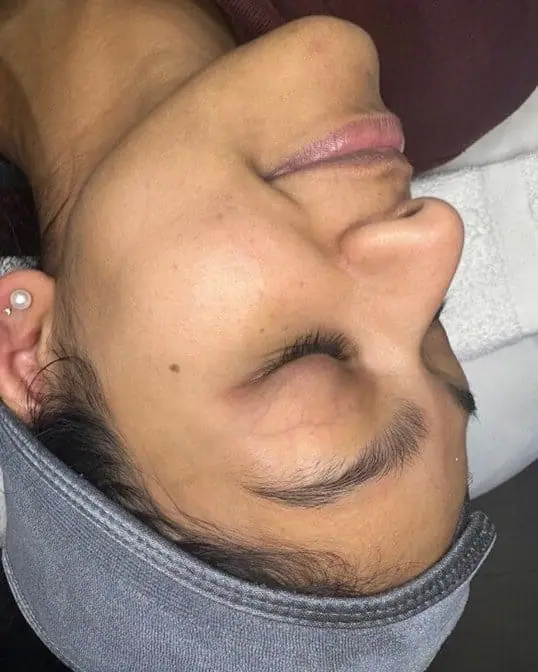 Signature HydraFacial® Glow Treatment before treatment