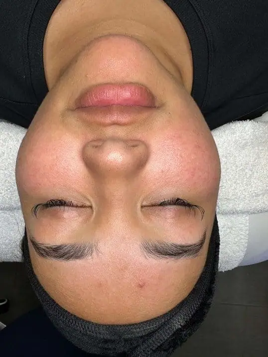 HydraFacial® for Glowing, Hydrated Skin before treatment