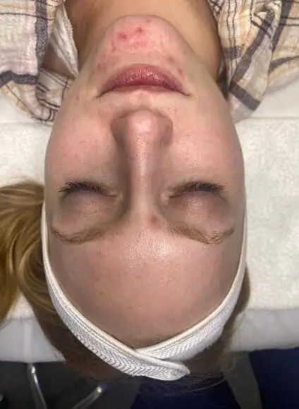 ZO Skin Health HydraFacial® Treatment before treatment
