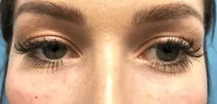 Injectables after treatment at ZO Skin Centre