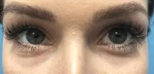 Treating Tear Trough's with Restylane Lyft before treatment