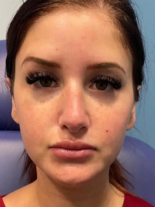 Restylane Contour in Mid Face before treatment