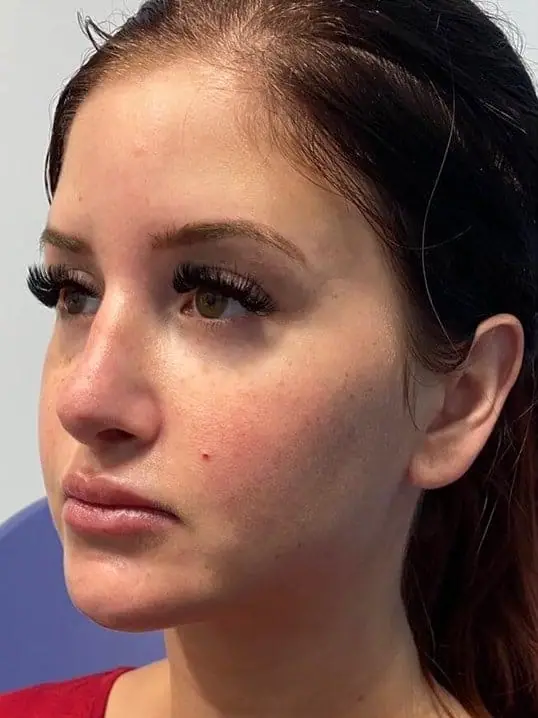 Beautiful Restylane Contour in Mid Face before treatment
