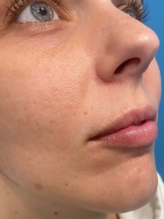 Restylane Defyne Filler before treatment