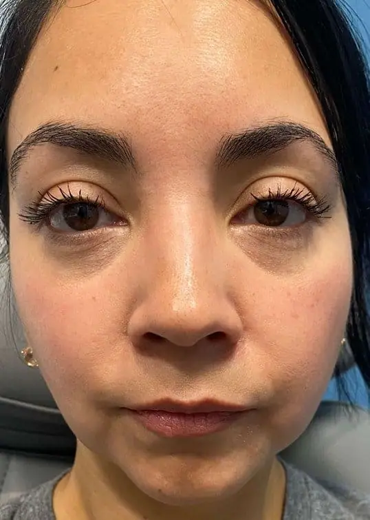 Mid Face & Tear Trough Filler before treatment