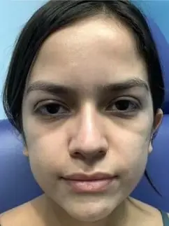 Restylane Contour Natural Looking Cheek Filler before treatment