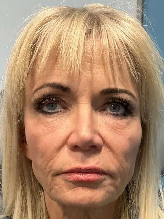 Restylane Lip & Chin Filler before treatment