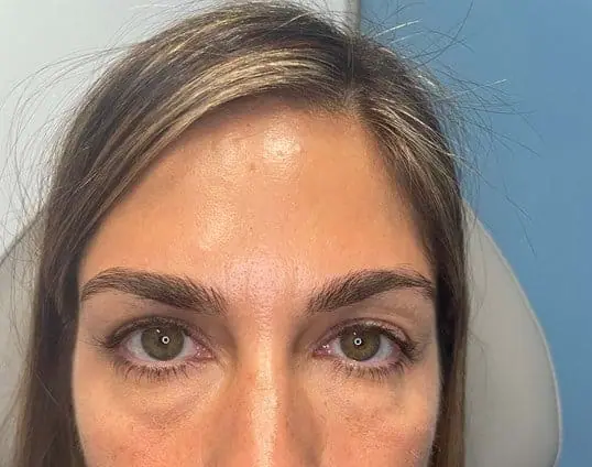 Restylane Dermal Filler Treatment before treatment