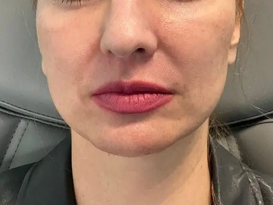 AMAZING Chin Filler Treatment before treatment