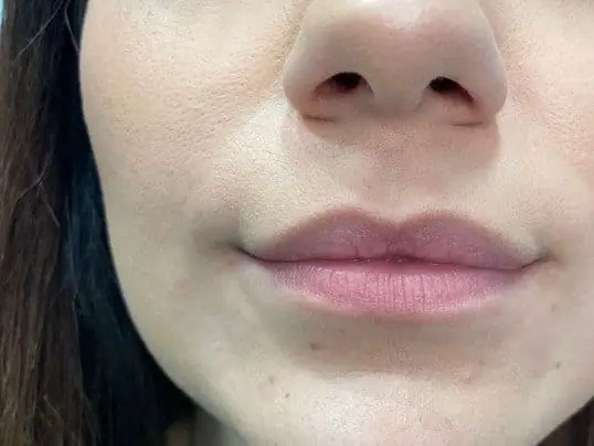 Restylane Refyne Dermal Filler before treatment