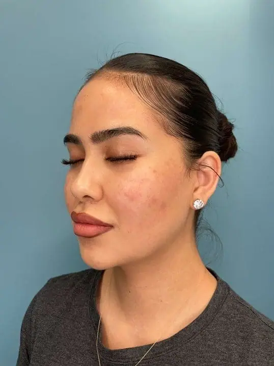 RHA Fillers May Be the Best Anti-Aging Injectable Yet! before treatment