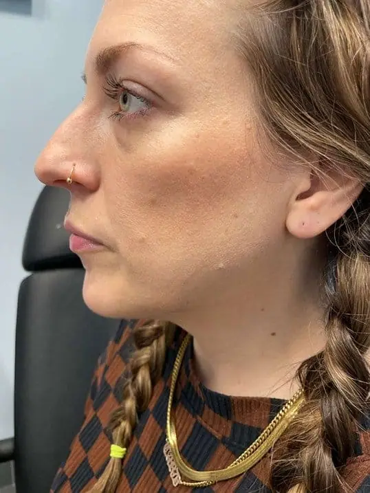 Jawline Contouring with Radiesse before treatment