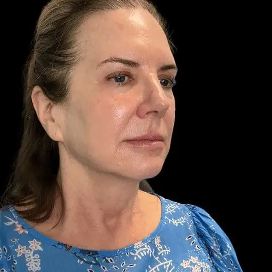 Sculptra® + Hyperdilute Radiesse Full-Face Rejuvenation before treatment