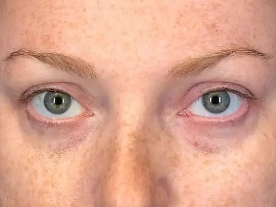 Under Eye Magic Using Restylane-L before treatment
