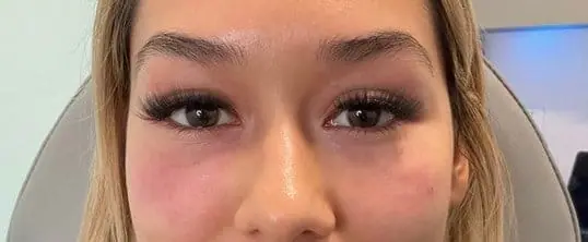 PRF EZ-Gel after treatment at ZO Skin Centre