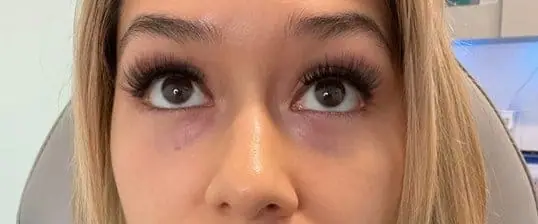 PRF EZ Gel Under-Eye Rejuvenation before treatment